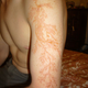 Illustration for article titled This is what your skin looks like after you've been struck by lightning